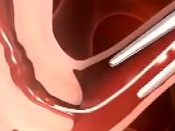 试管移植子宫内膜多厚比较好？